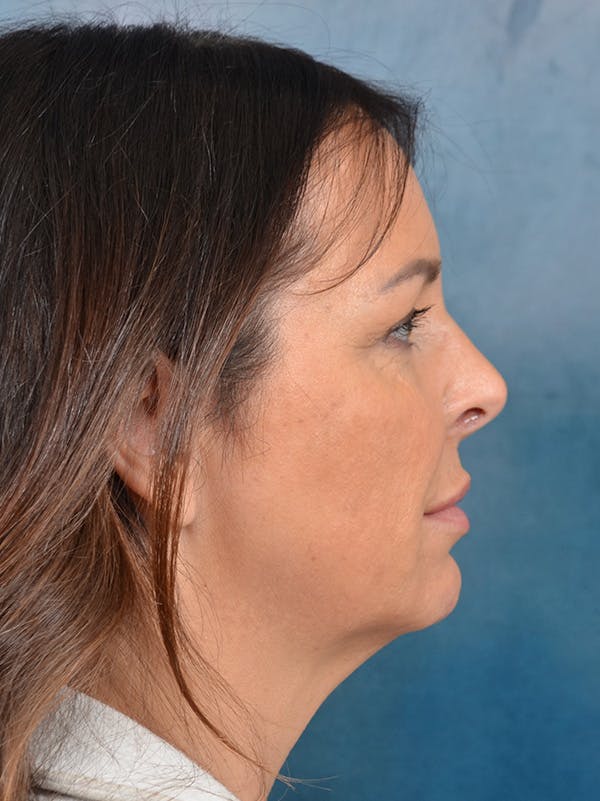 Brow Lift Before & After Gallery - Patient 148827532 - Image 7