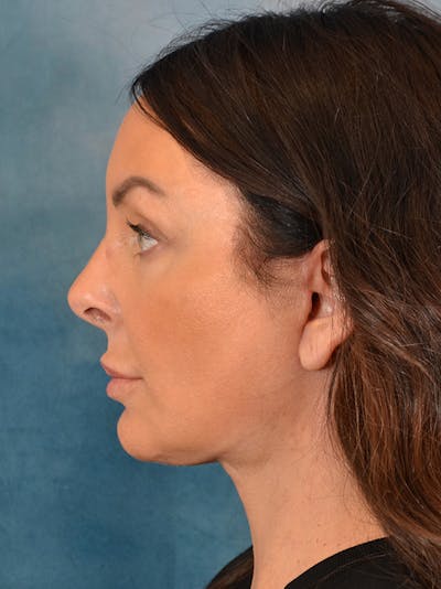 Brow Lift Before & After Gallery - Patient 148827532 - Image 10