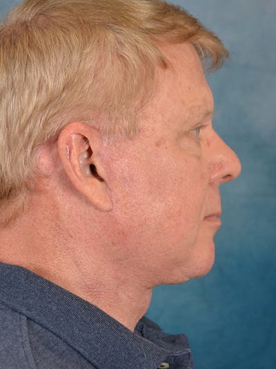 Deep Plane Facelift Before & After Gallery - Patient 149235942 - Image 8