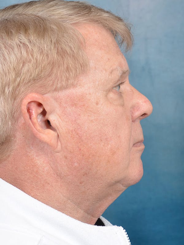 Deep Plane Facelift Before & After Gallery - Patient 149235942 - Image 7