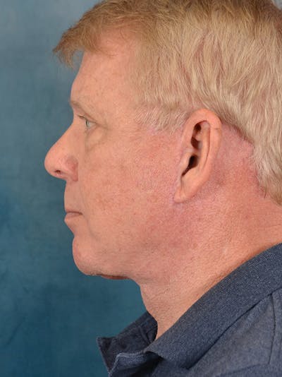Deep Plane Facelift Before & After Gallery - Patient 149235942 - Image 10