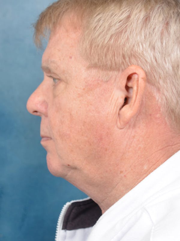 Deep Plane Facelift Before & After Gallery - Patient 149235942 - Image 9
