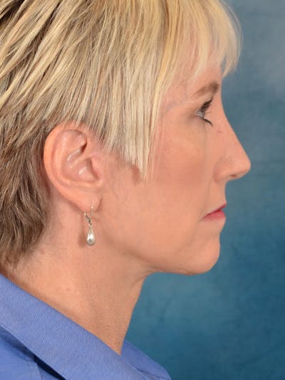 Deep Plane Facelift Before & After Gallery - Patient 148827567 - Image 8