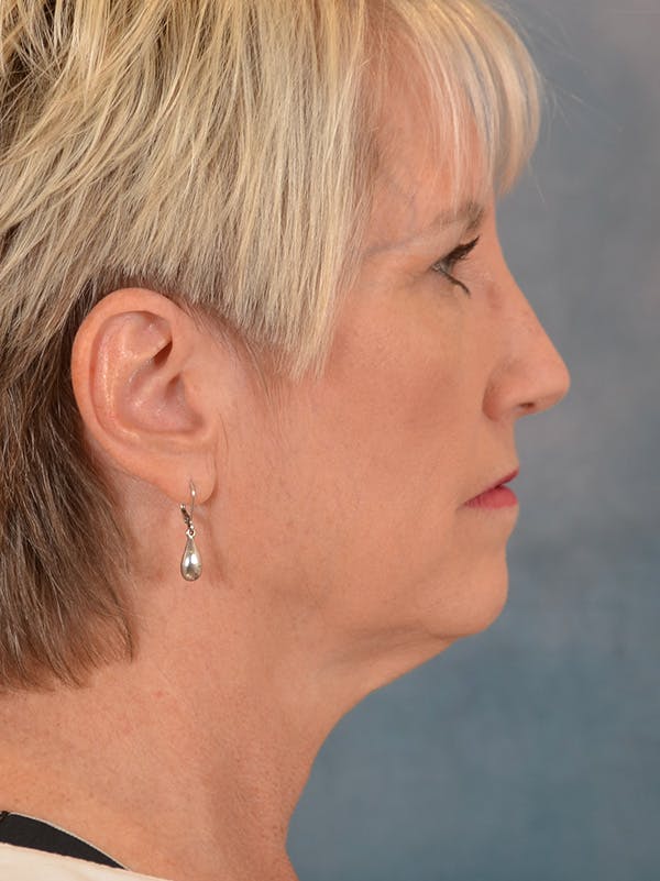 Deep Plane Facelift Before & After Gallery - Patient 148827567 - Image 7