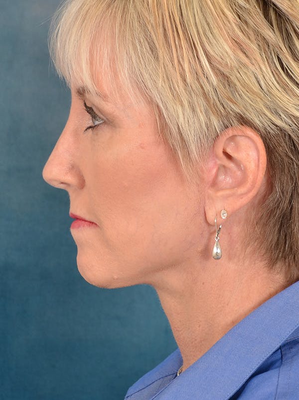 Deep Plane Facelift Before & After Gallery - Patient 148827567 - Image 10