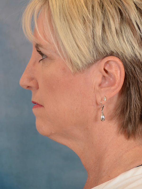 Deep Plane Facelift Before & After Gallery - Patient 148827567 - Image 9