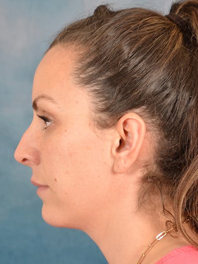 Rhinoplasty Before & After Gallery - Patient 146208709 - Image 1