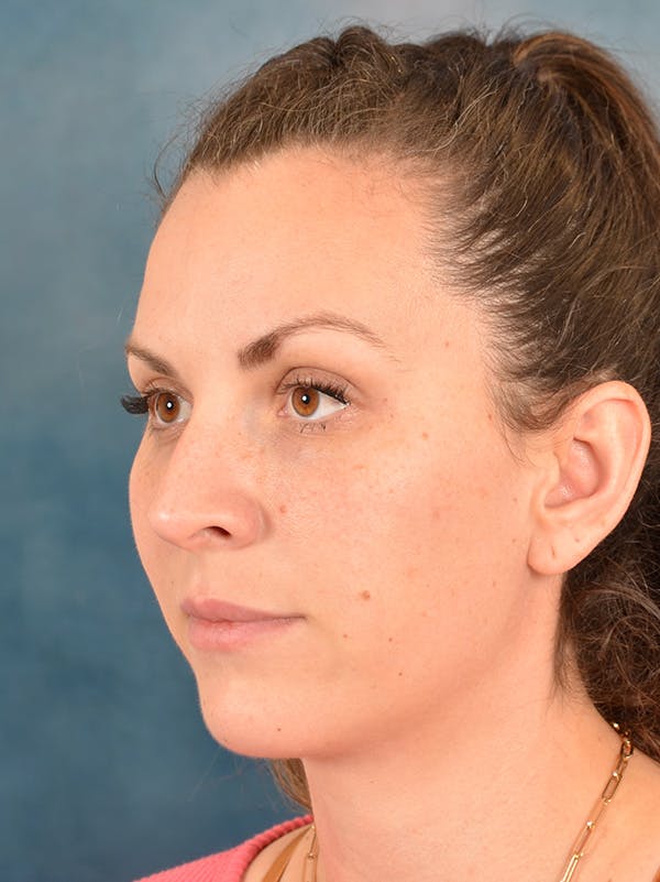Rhinoplasty Before & After Gallery - Patient 146208709 - Image 3