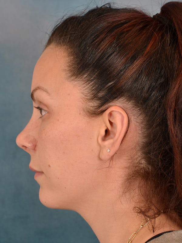 Rhinoplasty Before & After Gallery - Patient 146208709 - Image 2