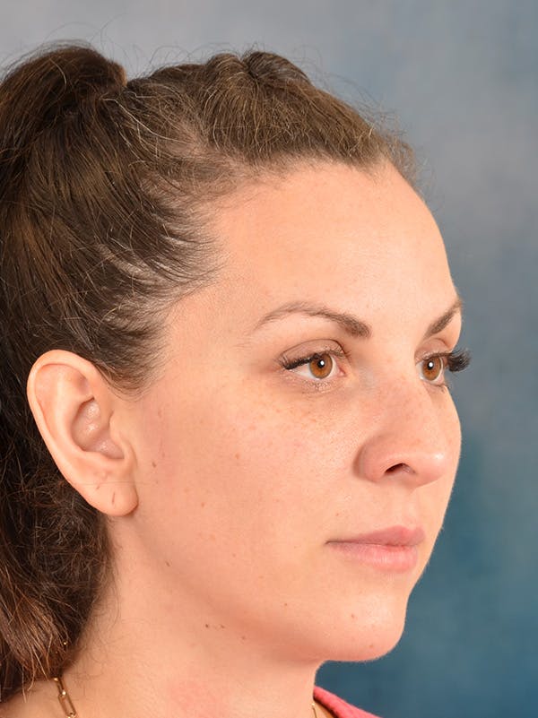 Rhinoplasty Before & After Gallery - Patient 146208709 - Image 7
