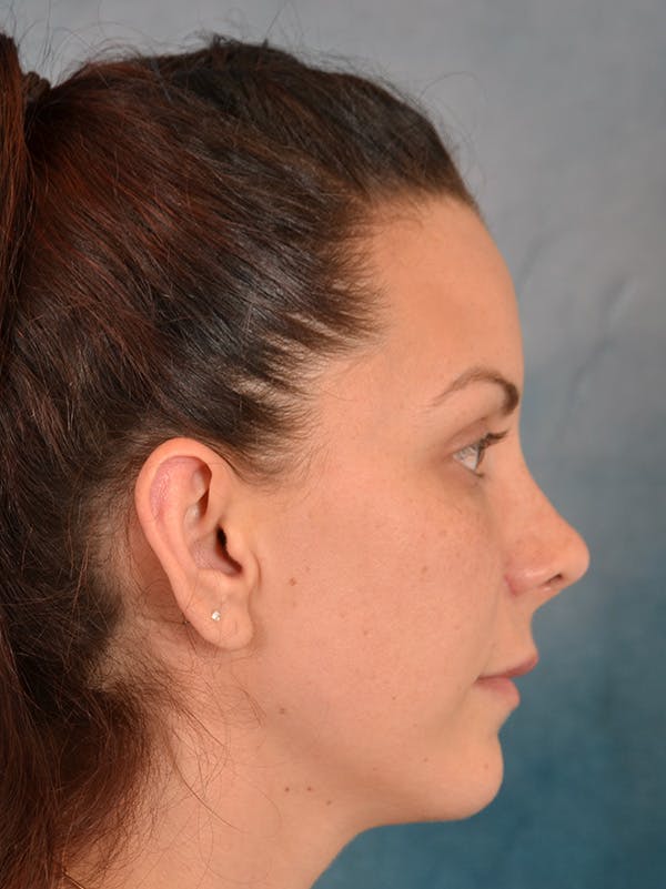 Rhinoplasty Before & After Gallery - Patient 146208709 - Image 10