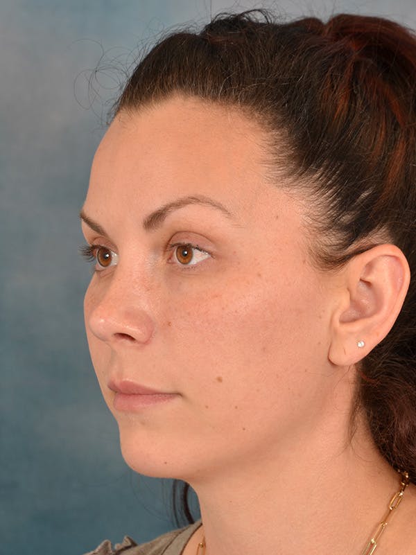 Rhinoplasty Before & After Gallery - Patient 146208709 - Image 4