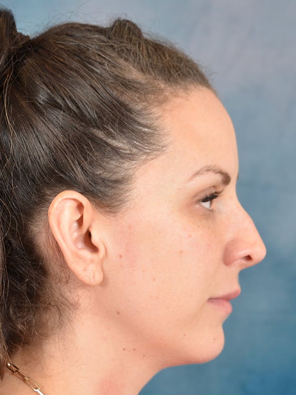 Rhinoplasty Before & After Gallery - Patient 146208709 - Image 9