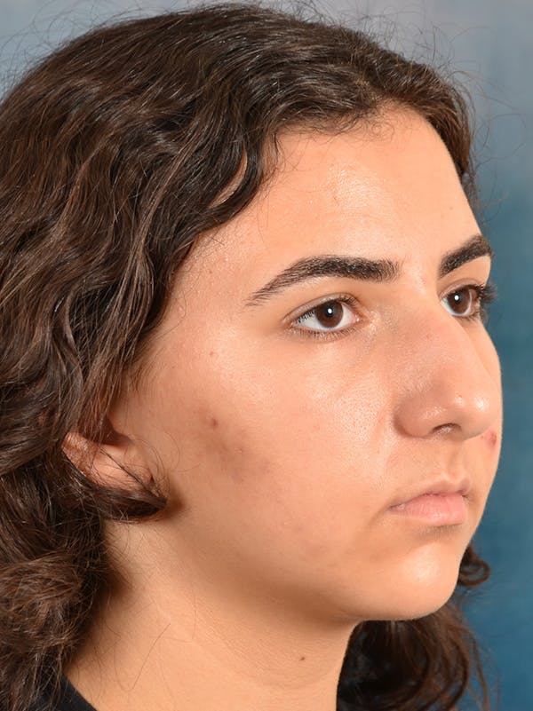 Rhinoplasty Before & After Gallery - Patient 148827539 - Image 5