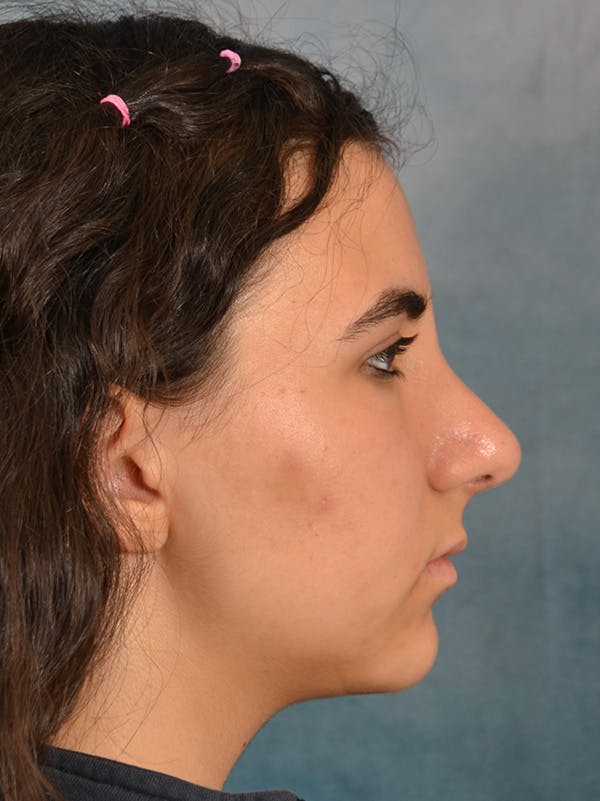 Rhinoplasty Before & After Gallery - Patient 148827539 - Image 8