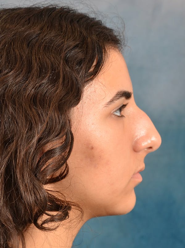 Rhinoplasty Before & After Gallery - Patient 148827539 - Image 7