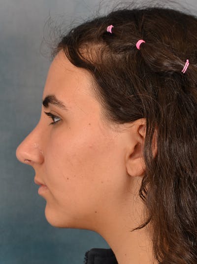 Rhinoplasty Before & After Gallery - Patient 148827539 - Image 2