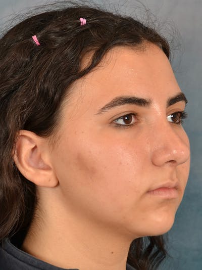 Rhinoplasty Before & After Gallery - Patient 148827539 - Image 6