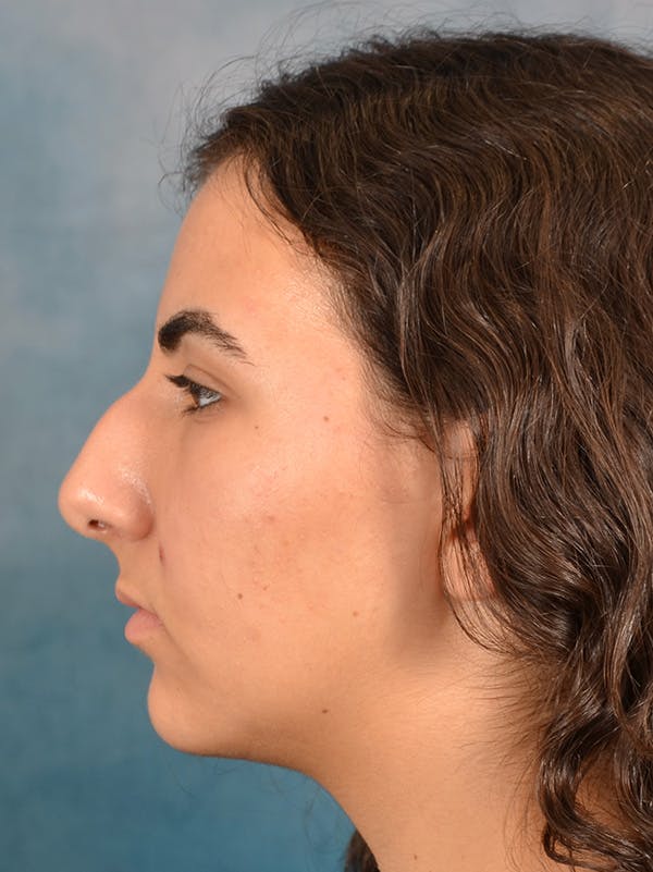 Rhinoplasty Before & After Gallery - Patient 148827539 - Image 1