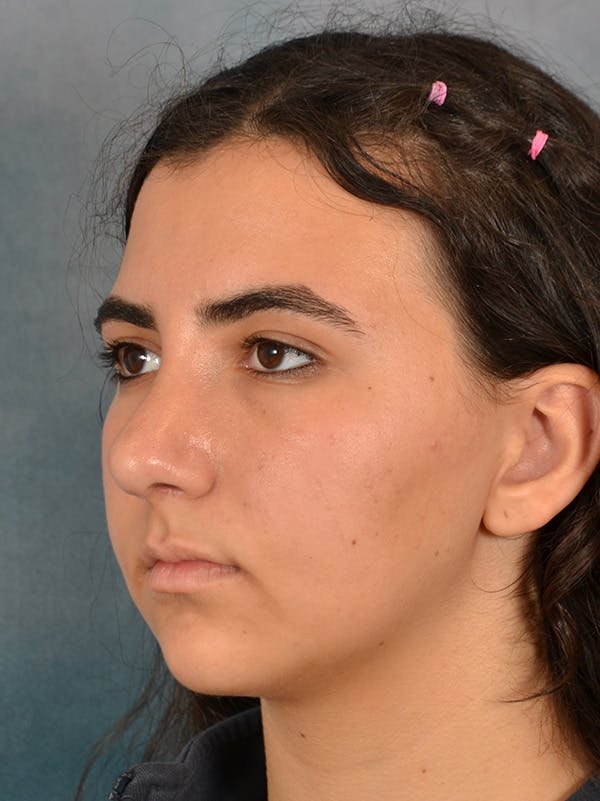 Rhinoplasty Before & After Gallery - Patient 148827539 - Image 10