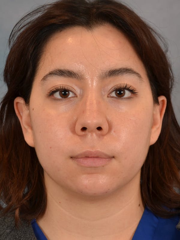 Rhinoplasty Before & After Gallery - Patient 149235910 - Image 3