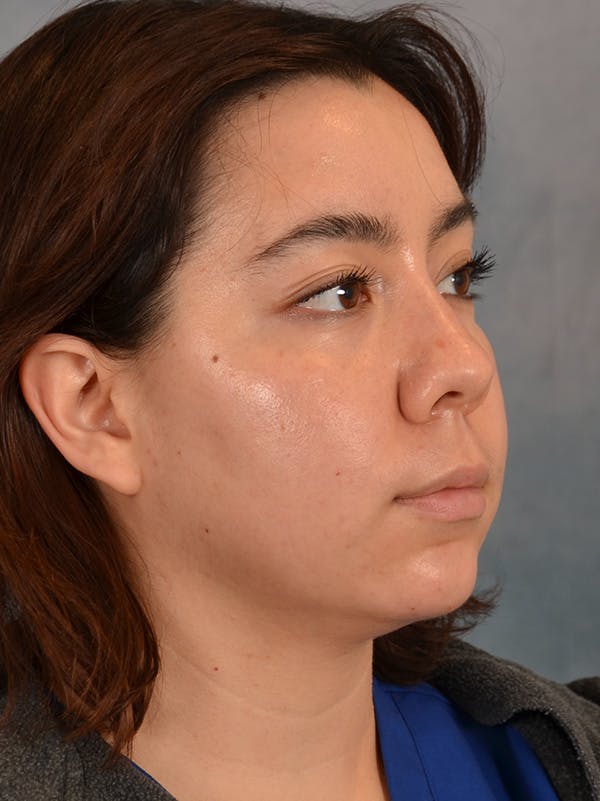 Rhinoplasty Before & After Gallery - Patient 149235910 - Image 5