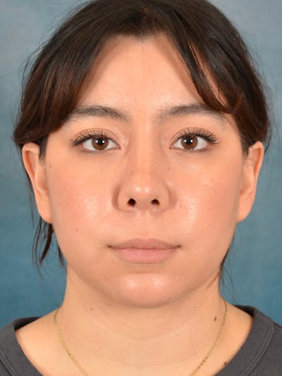 Rhinoplasty Before & After Gallery - Patient 149235910 - Image 4