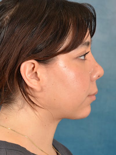 Deep Neck Lift Before & After Gallery - Patient 148972740 - Image 10