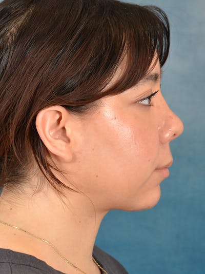 Rhinoplasty Before & After Gallery - Patient 149235910 - Image 8