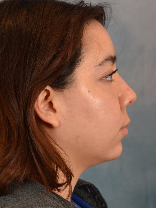 Deep Neck Lift Before & After Gallery - Patient 148972740 - Image 9