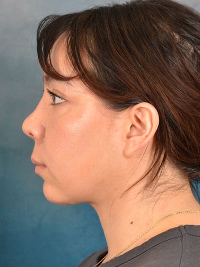 Deep Neck Lift Before & After Gallery - Patient 148972740 - Image 6