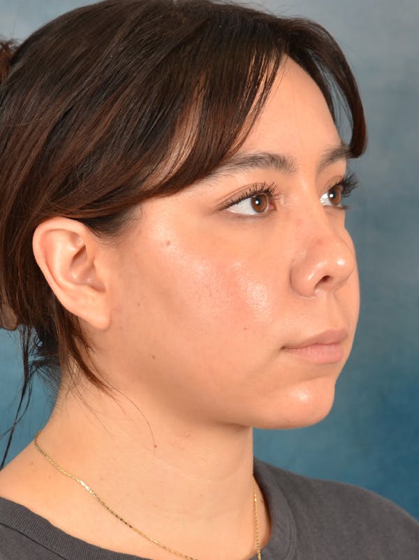 Rhinoplasty Before & After Gallery - Patient 149235910 - Image 6