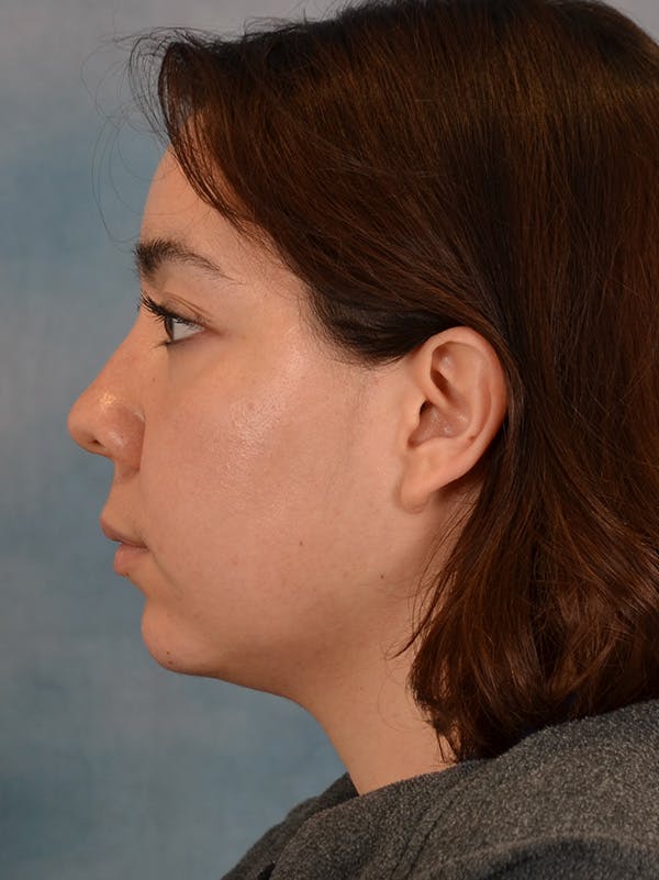 Deep Neck Lift Before & After Gallery - Patient 148972740 - Image 5
