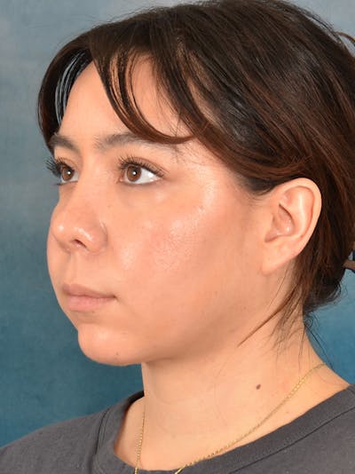 Deep Neck Lift Before & After Gallery - Patient 148972740 - Image 4