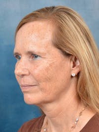 Deep Plane Facelift Before & After Gallery - Patient 148827541 - Image 1