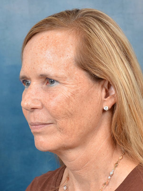 Deep Plane Facelift Before & After Gallery - Patient 148827541 - Image 1