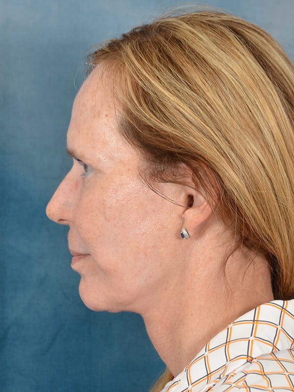 Laser Skin Resurfacing Before & After Gallery - Patient 149235953 - Image 6