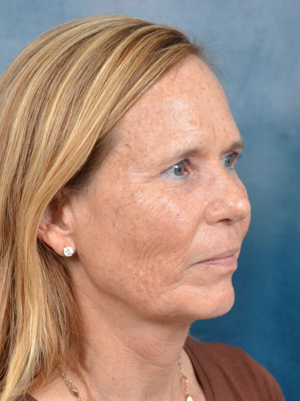Laser Skin Resurfacing Before & After Gallery - Patient 149235953 - Image 7
