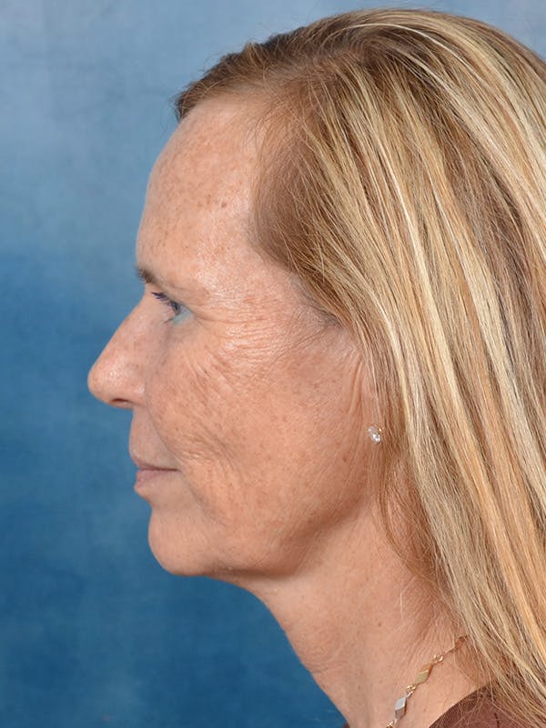 Deep Plane Facelift Before & After Gallery - Patient 148827541 - Image 5