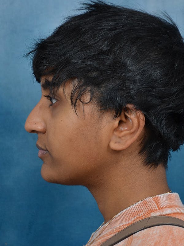 Rhinoplasty Before & After Gallery - Patient 149235915 - Image 1