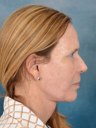 Deep Plane Facelift Before & After Gallery - Patient 148827541 - Image 10