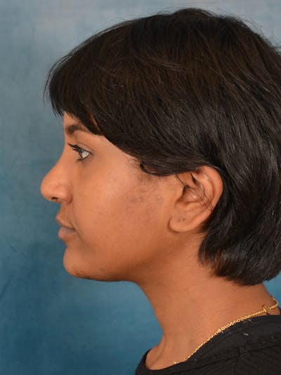 Rhinoplasty Before & After Gallery - Patient 149235915 - Image 2