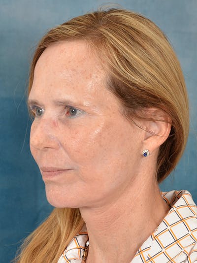 Deep Plane Facelift Before & After Gallery - Patient 148827541 - Image 2