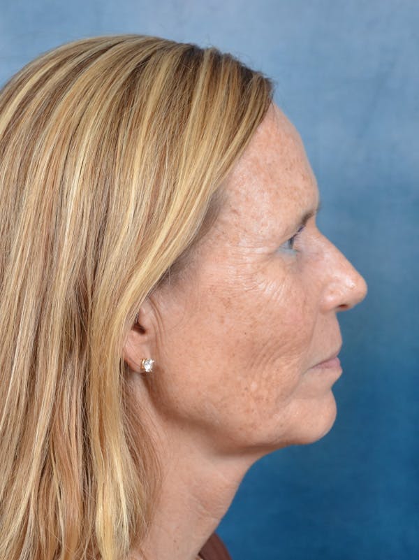 Deep Plane Facelift Before & After Gallery - Patient 148827541 - Image 9