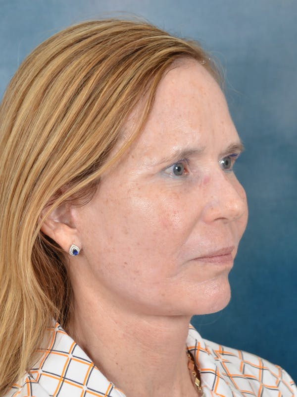 Laser Skin Resurfacing Before & After Gallery - Patient 149235953 - Image 8