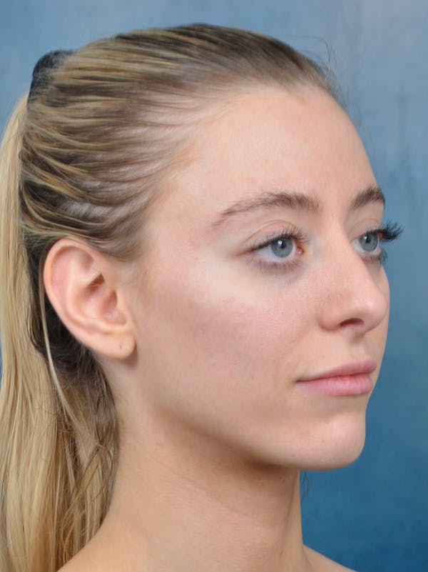 Rhinoplasty Before & After Gallery - Patient 148827492 - Image 5