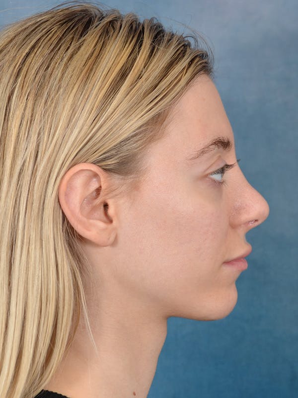 Rhinoplasty Before & After Gallery - Patient 148827492 - Image 8