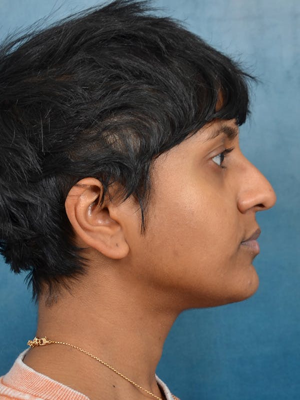 Rhinoplasty Before & After Gallery - Patient 149235915 - Image 9