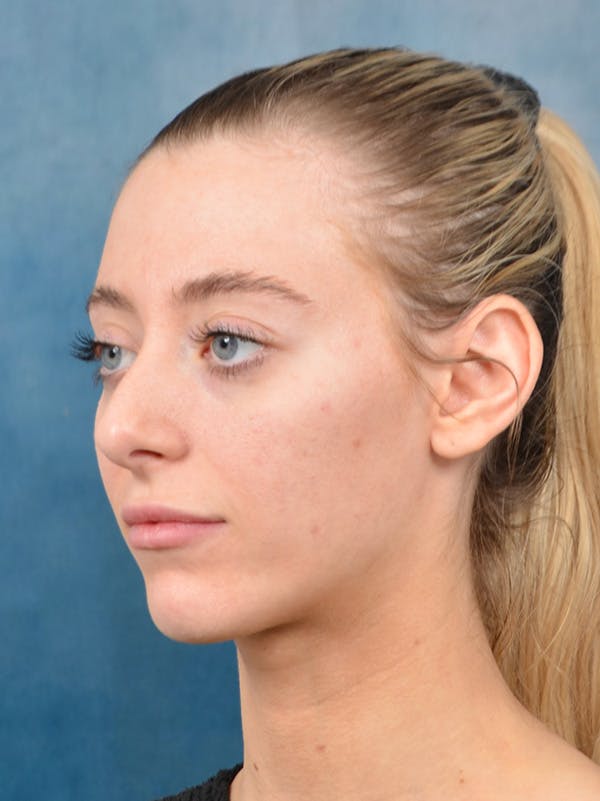 Rhinoplasty Before & After Gallery - Patient 148827492 - Image 9