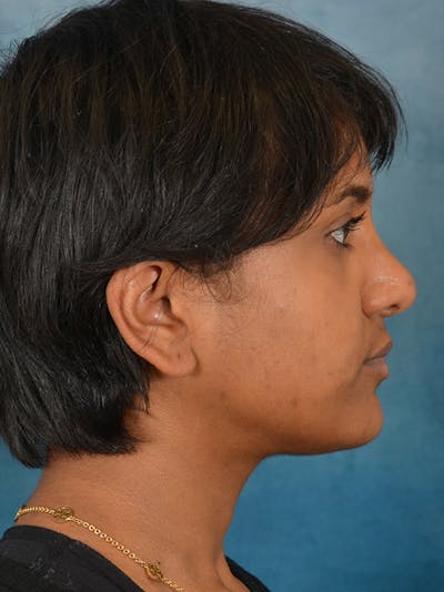 Rhinoplasty Before & After Gallery - Patient 149235915 - Image 10